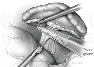 Laparoscopic Splenectomy Procedure Thumbnail