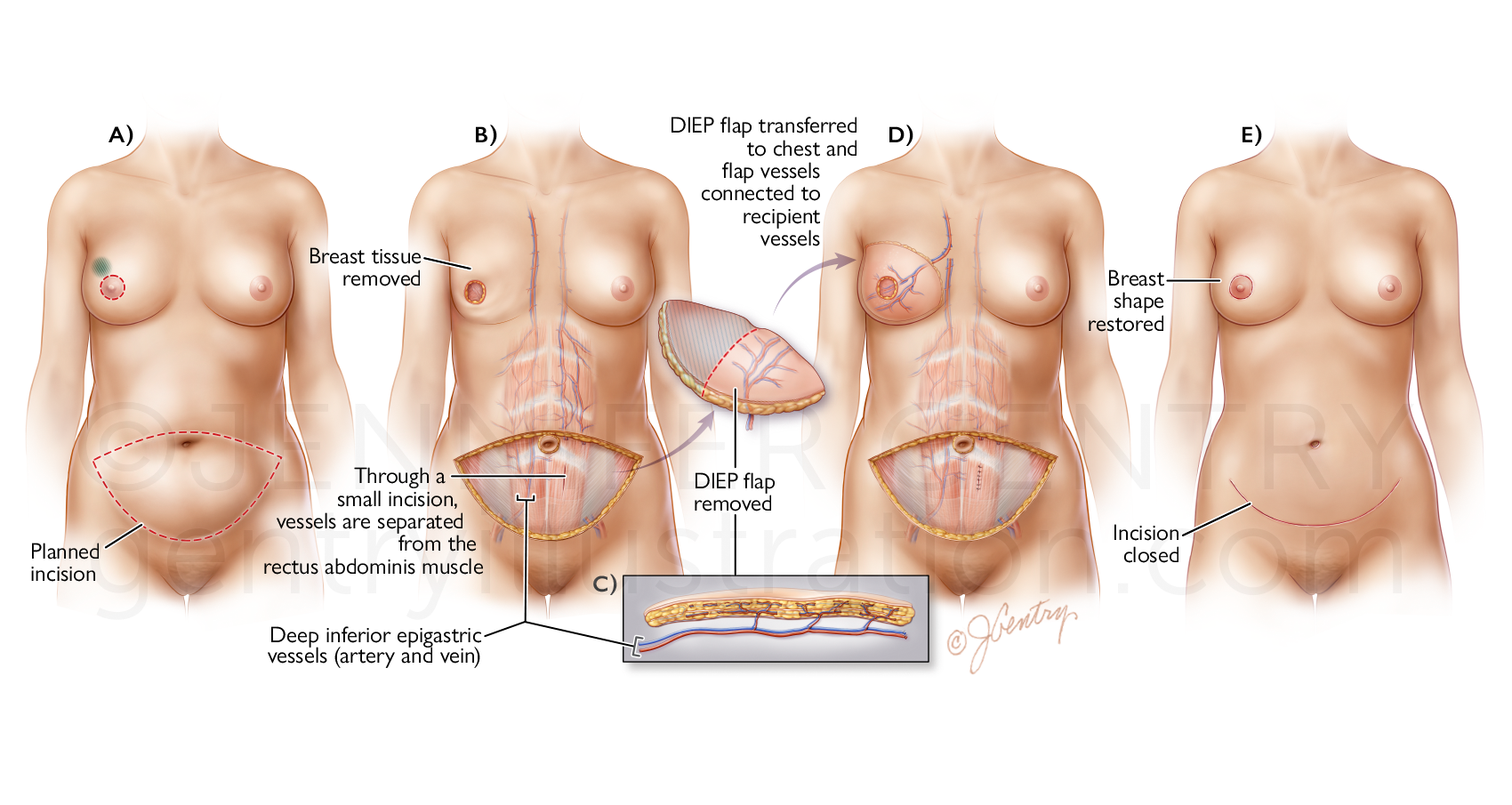 DIEP Flap Breast Reconstruction (Deep Inferior Epigastric Artery Perforator)
