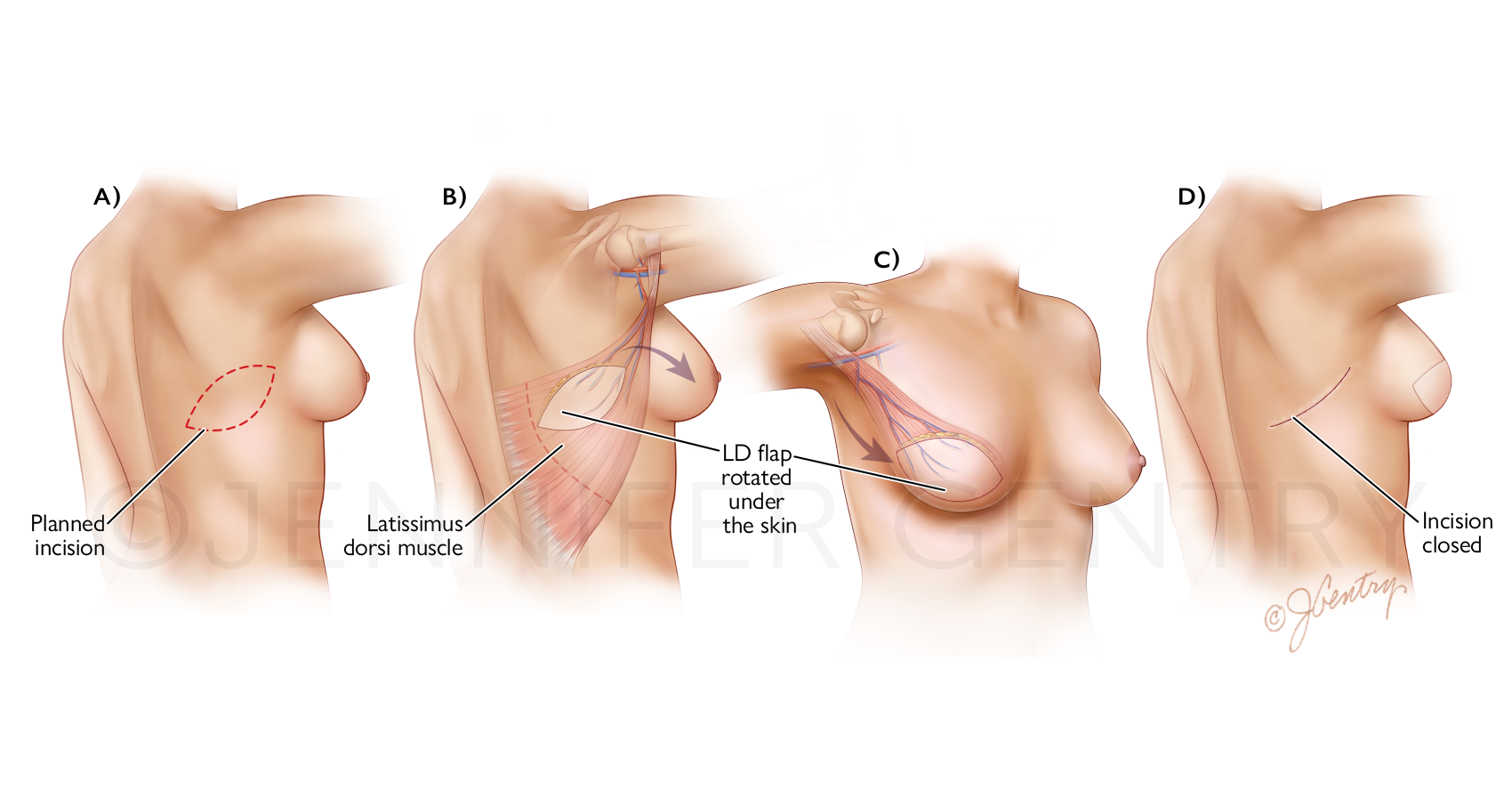 Breast Reconstruction: Latissimus Dorsi Flap