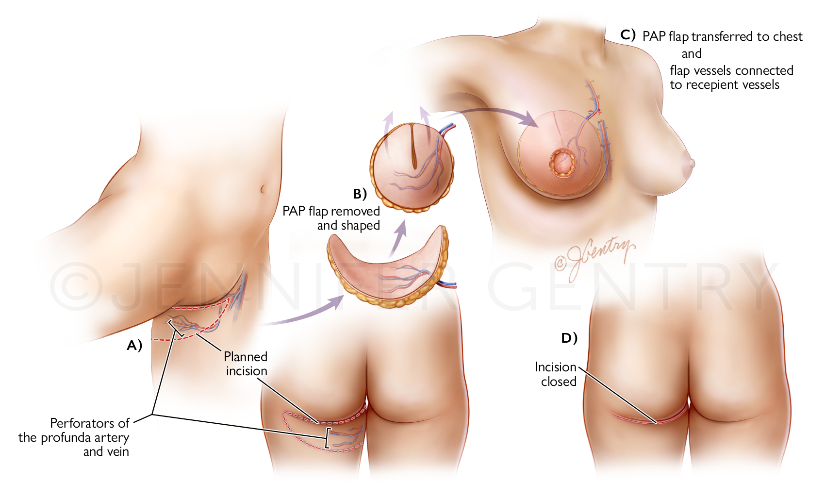 PAP Flap Breast Reconstruction