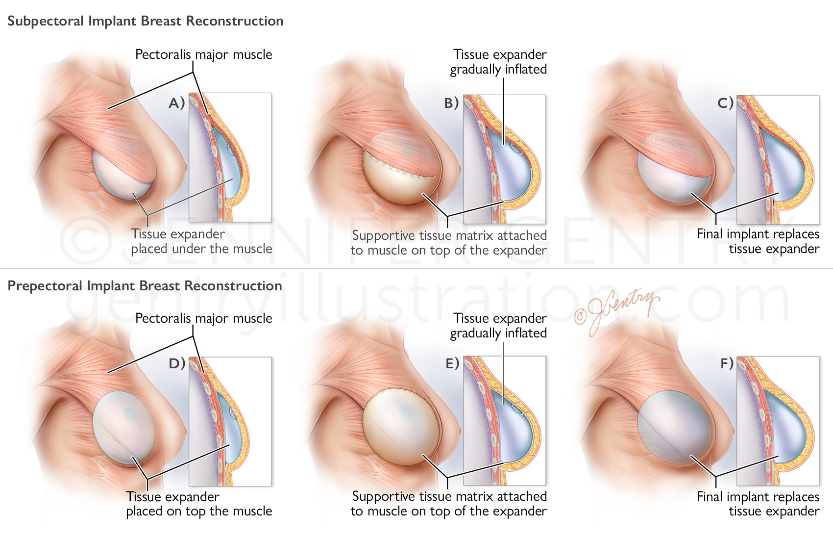 Breast Reconstruction: Prepectoral and Subpectoral Implant Procedure using Tissue Expander