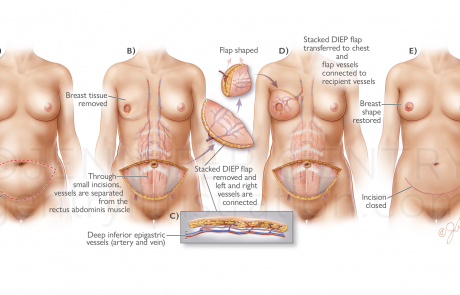 Breast Reconstruction: Stacked Deep Inferior Epigastric Artery Perforator (Stacked DIEP) Flap Procedure