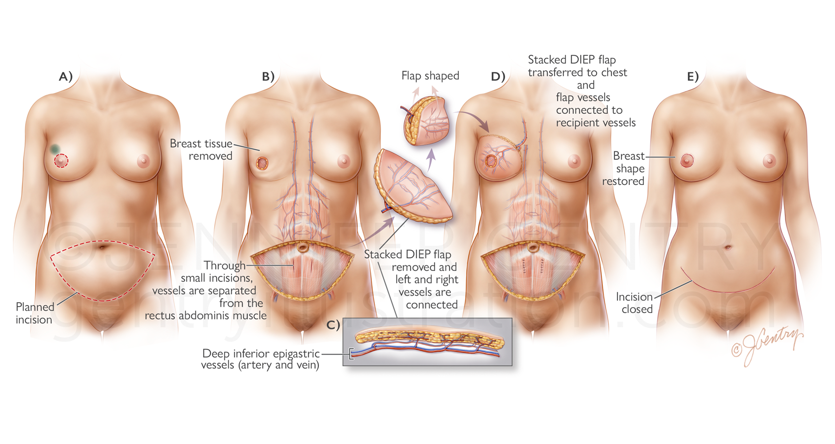 Breast Reconstruction: Stacked Deep Inferior Epigastric Artery Perforator (Stacked DIEP) Flap Procedure