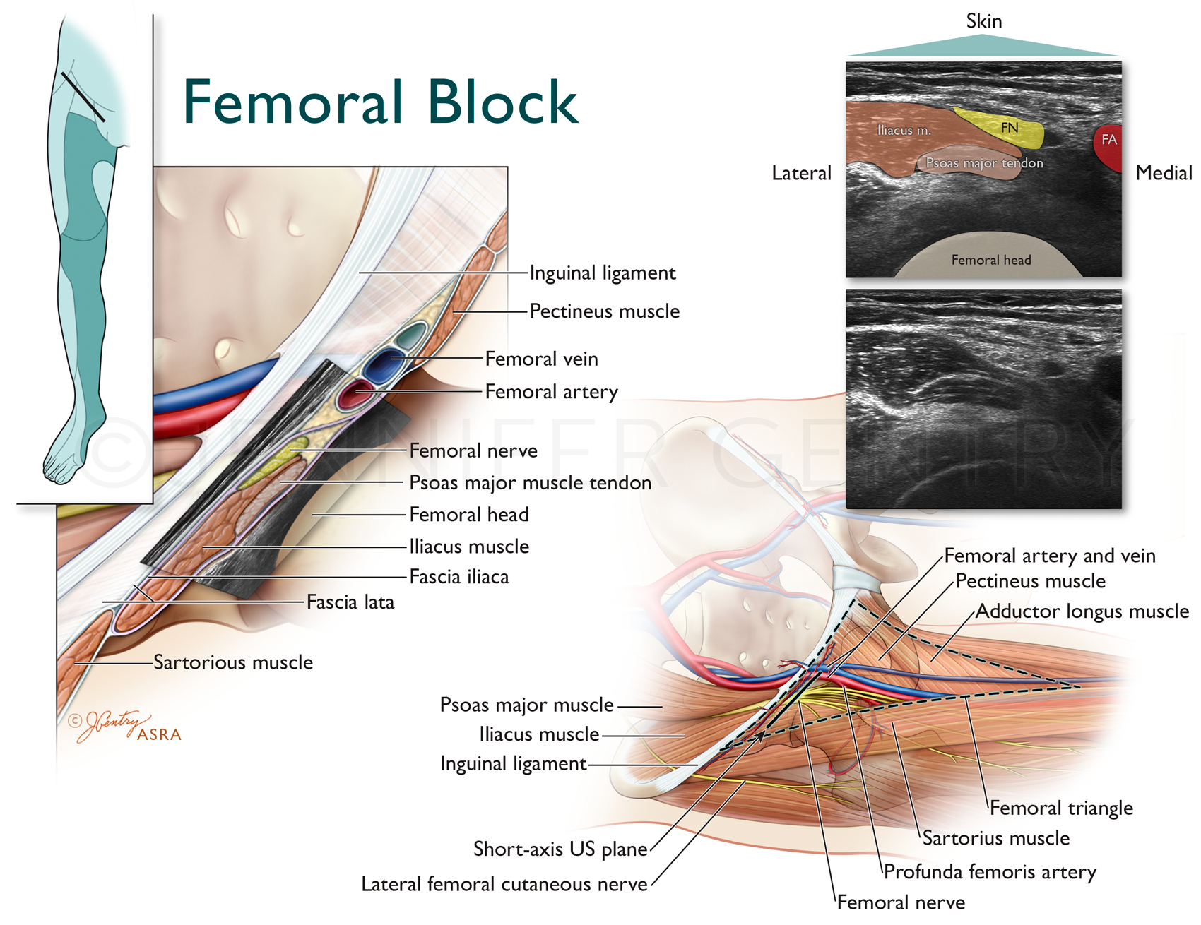 Femoral Nerve Block