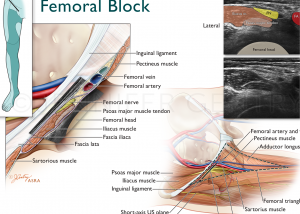 Femoral Nerve Block, Thumbnail