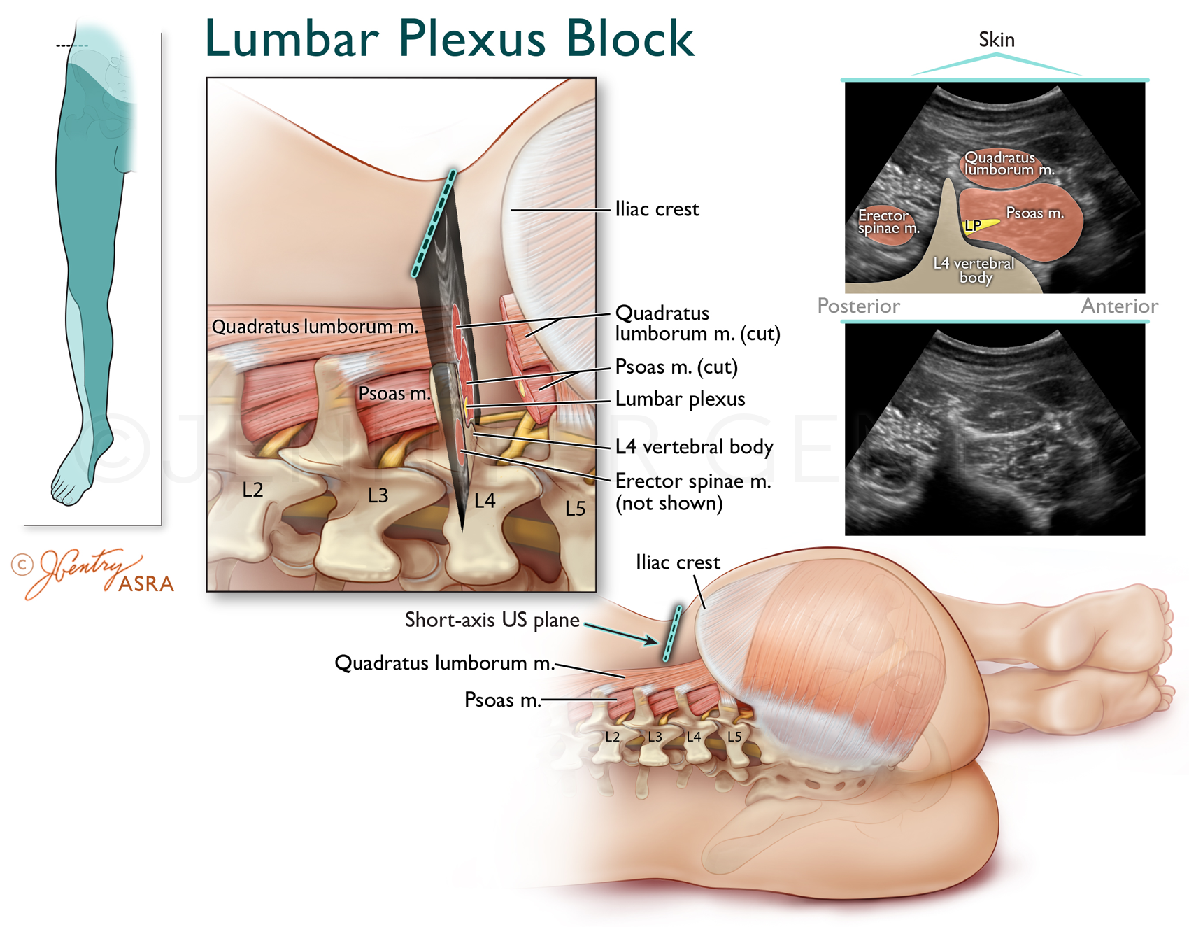 Lumbar Plexus Nerve Block